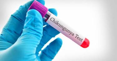 A Definite Guide to Everything about Chikungunya