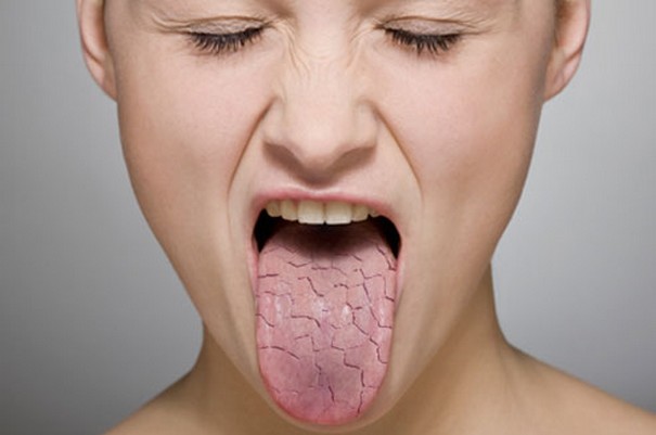 Bad Breath and Dry Mouth