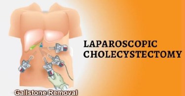 Gallstones Laparoscopic Surgery Removal
