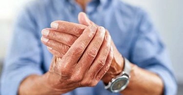 How to treat arthritis