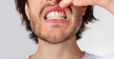 common causes of gum disease